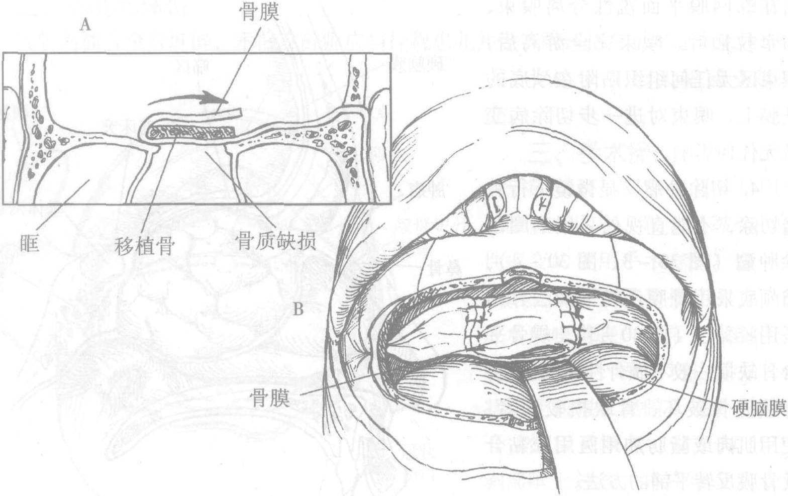 第三十章 前顱凹底腫瘤切除術(shù)
